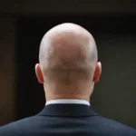 Por qué algunas personas pierden el cabello y están calvos